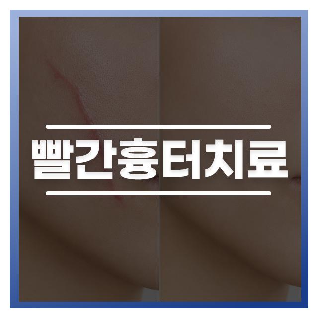 빨간흉터치료 상태에 따라 꼼꼼하고 다르게 치료해야 합니다