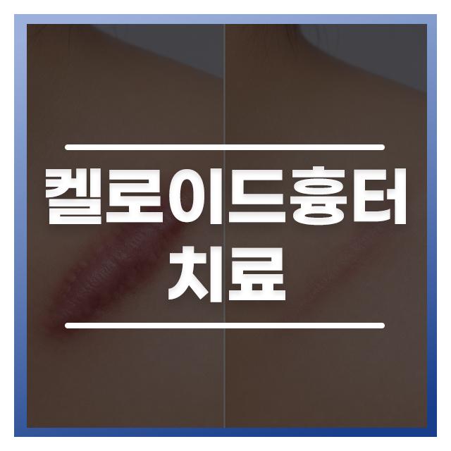 켈로이드흉터 더공감 흉터 리페어 프로그램으로 변화를 기대해보세요